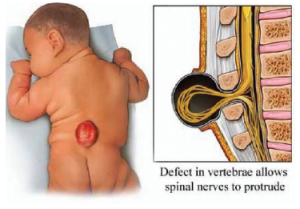 spina-bifida-baby